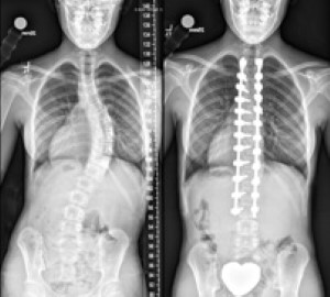 X-ray of Jessie's spine before and after surgery, showing it curved then straight.