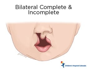 An artist's drawing of the bottom half of a baby's face. The upper lip on the left side extends all the way up to the nose while the right side extends only partway up to the nose.