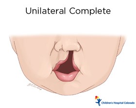 An artist's drawing of the bottom half of a baby's face. The upper lip extends up to the nose on the right side only.