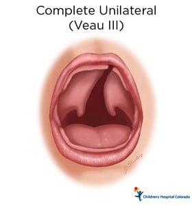 An artist's drawing of a baby's open mouth. In the back of the mouth, the flesh is disconnected in the middle.