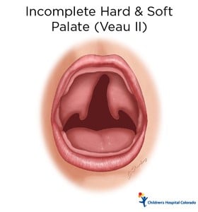 An artist's drawing of a baby's open mouth. In the back of the mouth, the flesh is disconnected and has a wide gap.