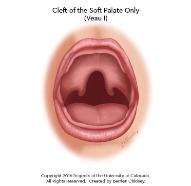 Drawing of cleft palate that involves the soft palate only