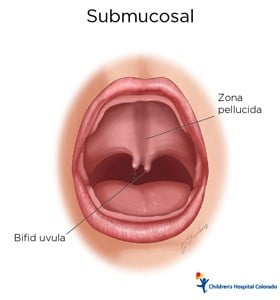 An artist's drawing of a baby's open mouth. In the back of the mouth, the flesh is thick and connected and there is a line to the part in the middle that says Zona pellucida and a line to the flesh hanging down in the middle that says Bifid uvulva.