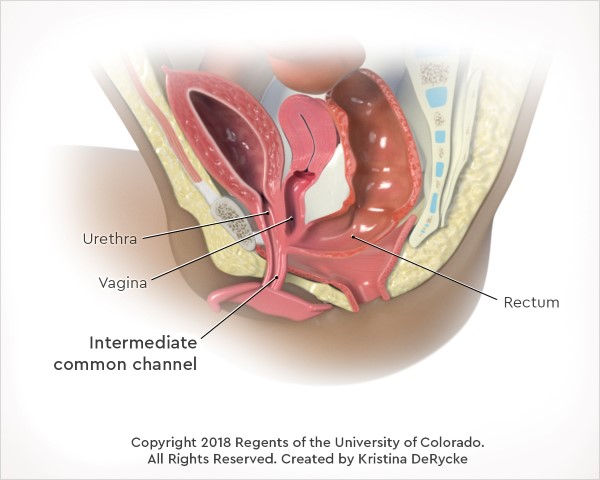 Illustration showing a cloacal malformation with an intermediate common channel (between 3 and 5 cm in length).