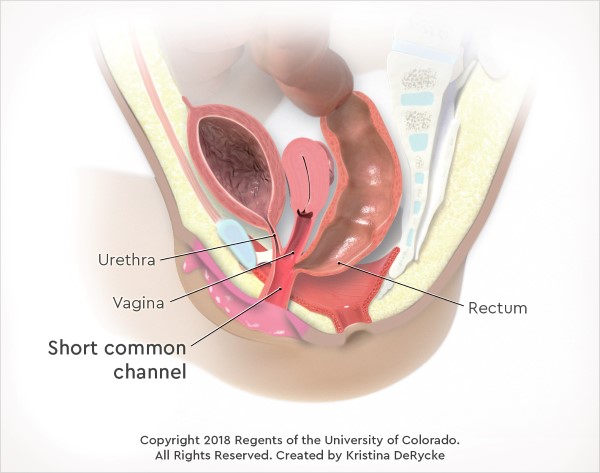 Illustration showing a cloacal malformation with a short common channel (less than 3 cm in length).