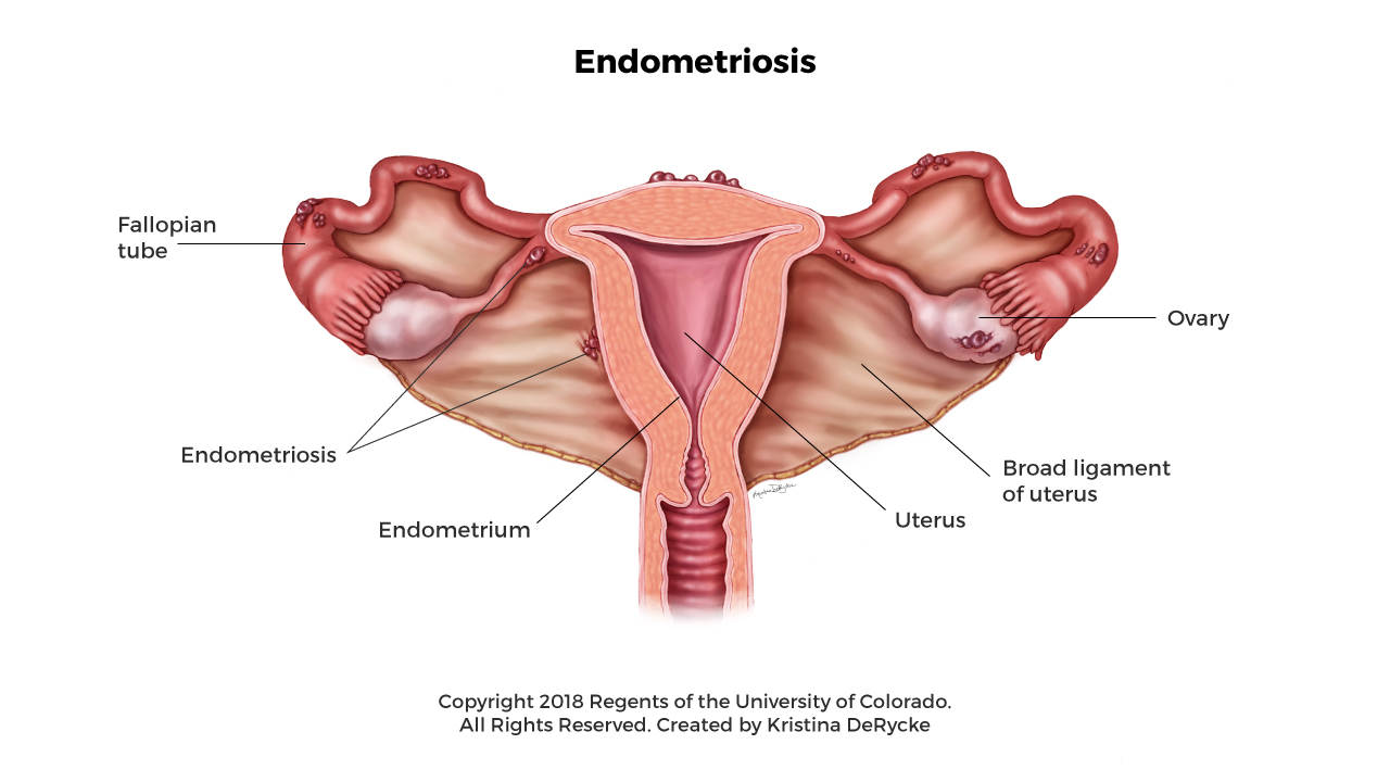 Endometriosis