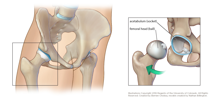 An illustration of the hip joint showing the ball out of the socket.