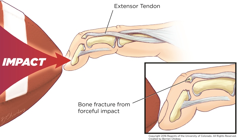 An illustration of mallet finger, showing where the impact occurs at the tip of the finger causing the bone to fracture. It also shows where the extensor tendon connects to the fractured bone.