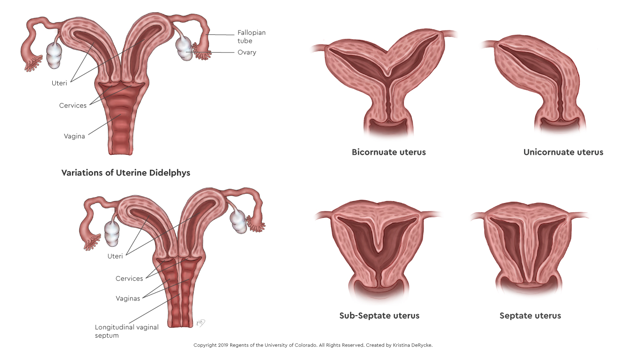 Müllerian Anomalies.jpg