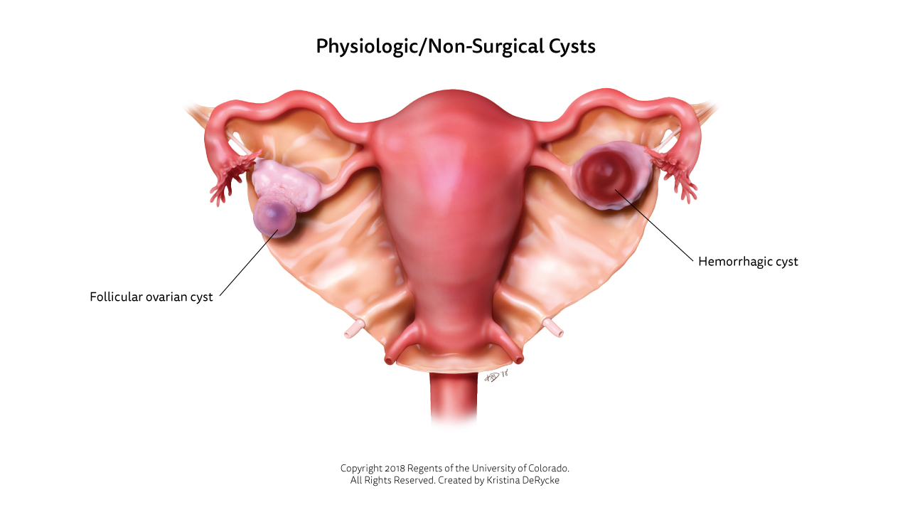 Medical illustration of non-surgical cysts: follicular ovarian and hemorrhagic.