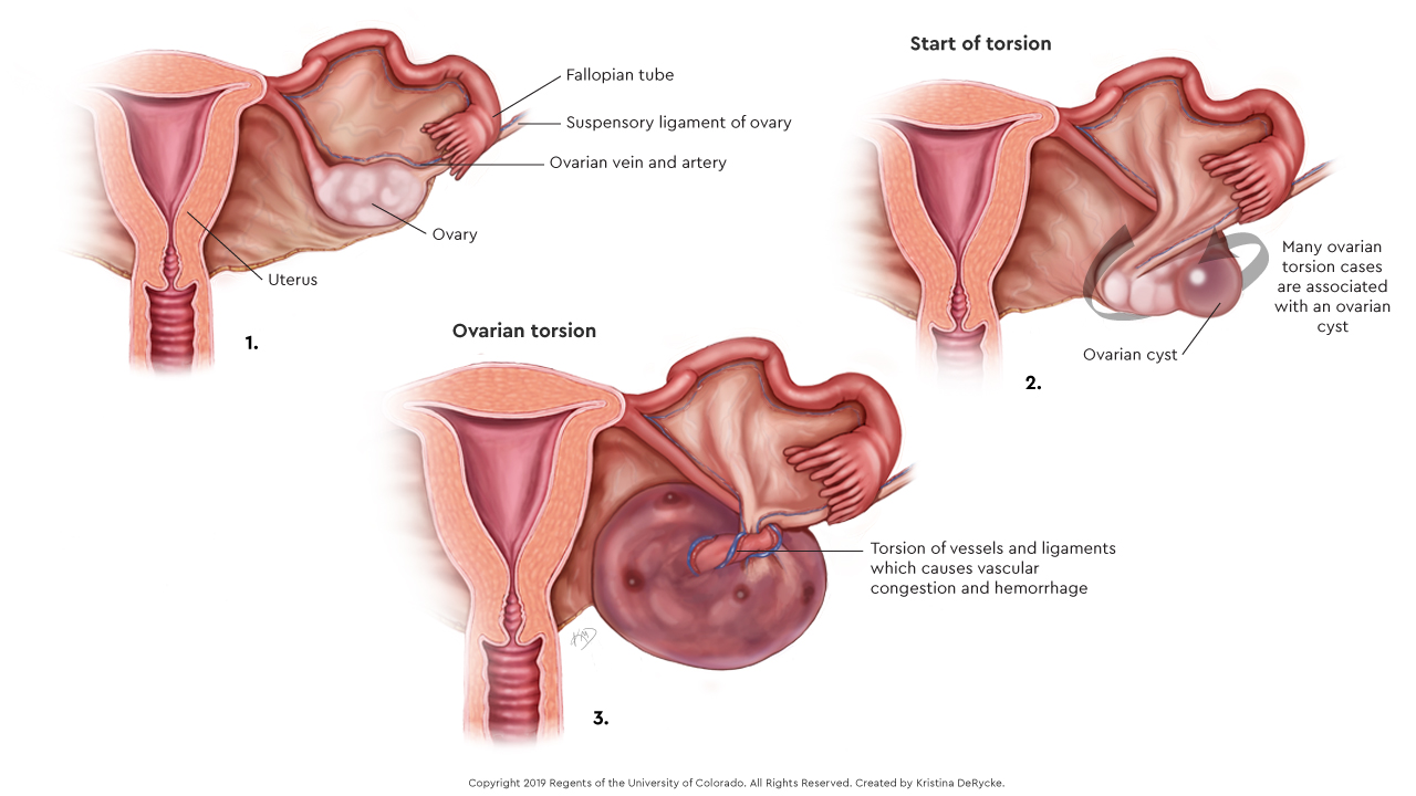 Illustration showing how ovarian torsion can twist the ovary and block the flow of blood.