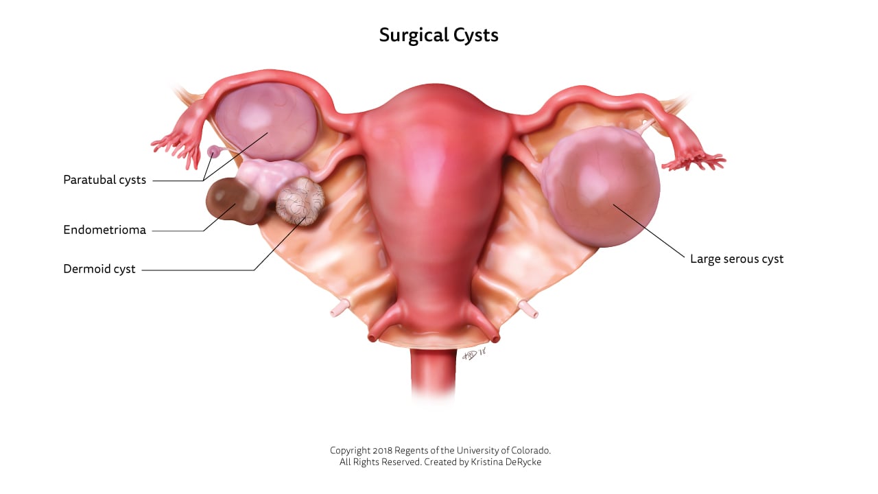 Medical illustration of surgical cysts: paratubal, endometrioma, dermoid and large serous.