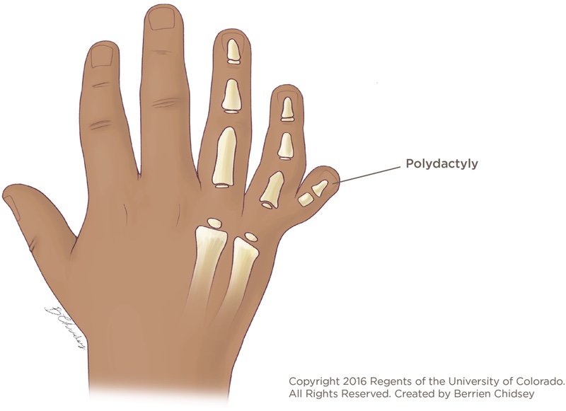 Polydactyly