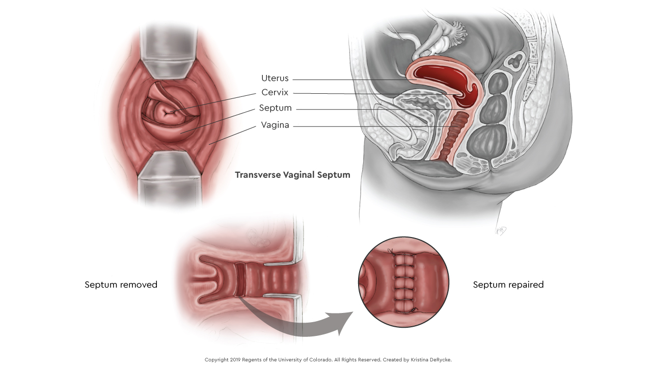 Vaginal Septum_web.jpg