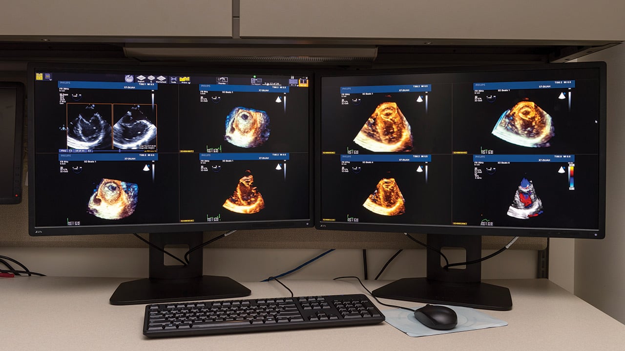 Computer monitors show images of the heart from echocardiogram (ECHO) tests.