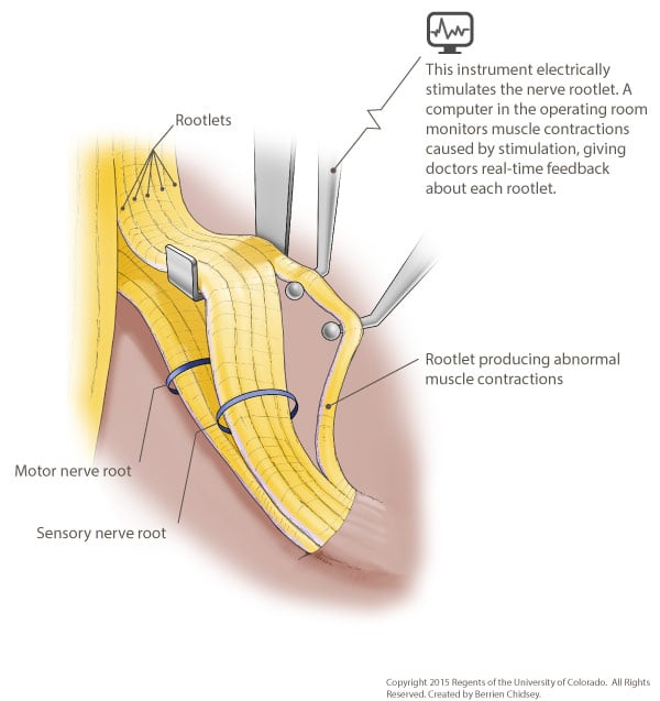 A graphic rendering of the spinal cord with motor nerve root and sensory nerve root identified.