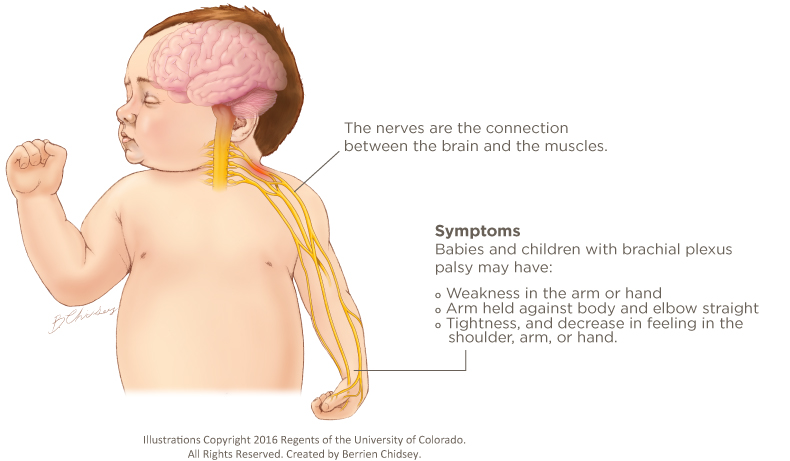 An illustration of a baby that shows the brain with nerves connecting the brain and arm muscles. It lists the symptoms of brachial plexus palsy as weakness in the arm or hand, arm held against body and elbow straight, tightness and decrease in feeling in the shoulder, arm or hand.