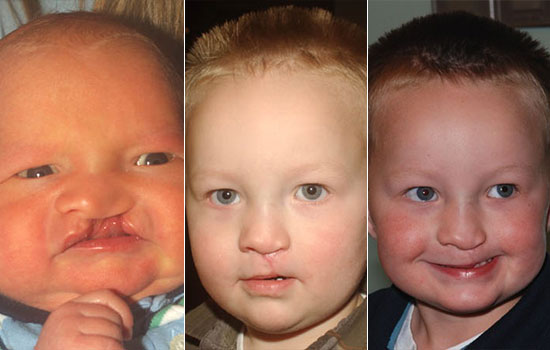 Three close-up pictures of the same boy before and after cleft surgery. The first picture is before surgery as a baby. The second picture is as a toddler after surgery. The third picture is after the scar healed.