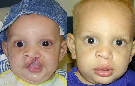 Two close-up pictures of the same baby boy with big brown eyes before and after cleft surgery.