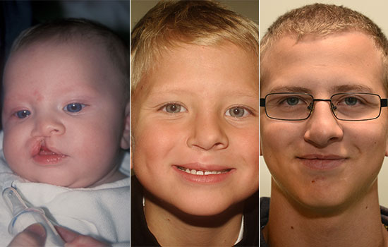 Three close-up pictures of the same boy before and after cleft surgery. The first picture is before surgery as a baby. The second picture is as a young boy after surgery. The third picture is as a teenager after the scar healed.