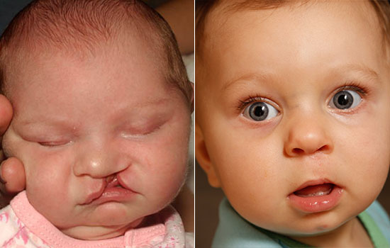 Two close-up pictures of the same baby girl before and after cleft surgery.