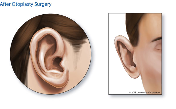 A close-up illustration of a healthy ear after otoplasty surgery.