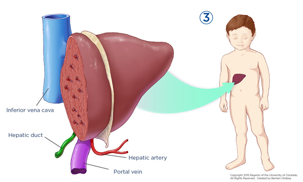 An illustration of a liver cut open and a blue arrow pointing from it to an illustration of a child with the liver showing.