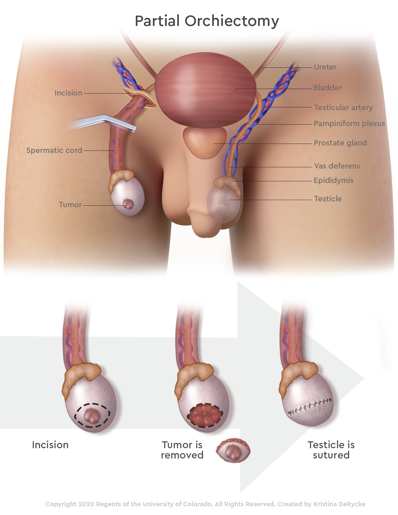 Testicular-Partial-Orchiectomy_v01.png