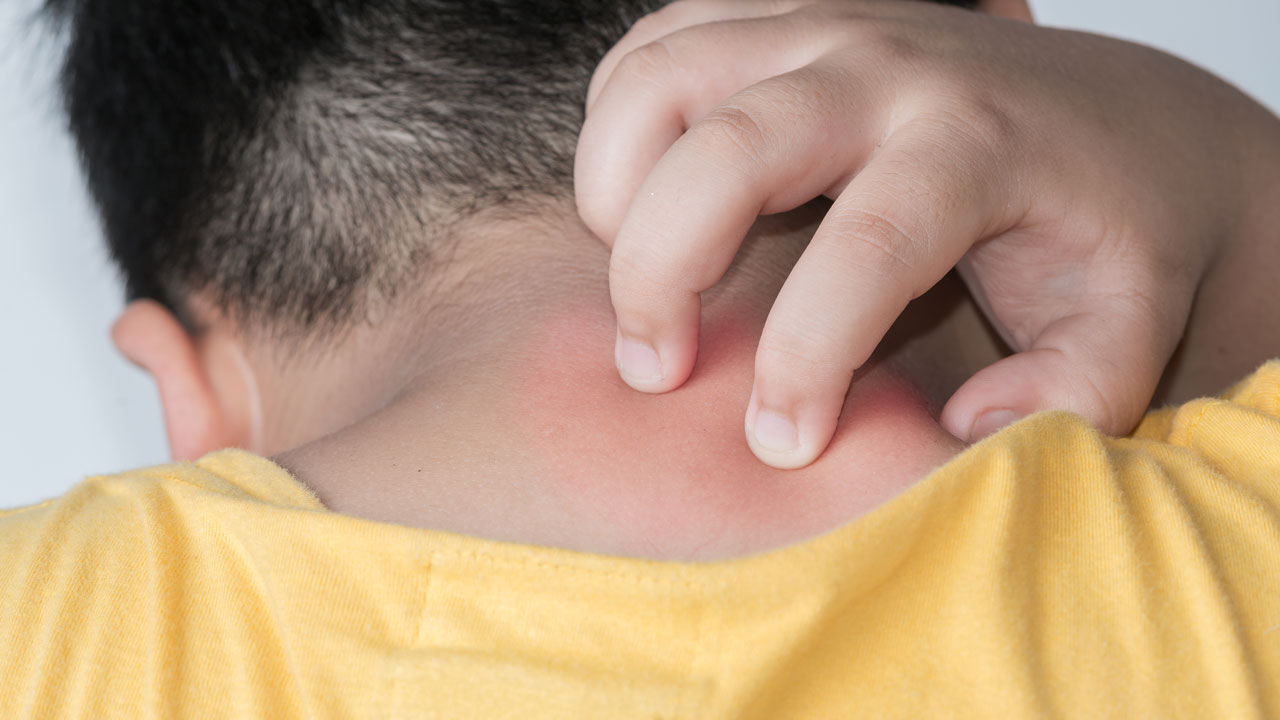 Young kid scratching a red rash on the back of the neck