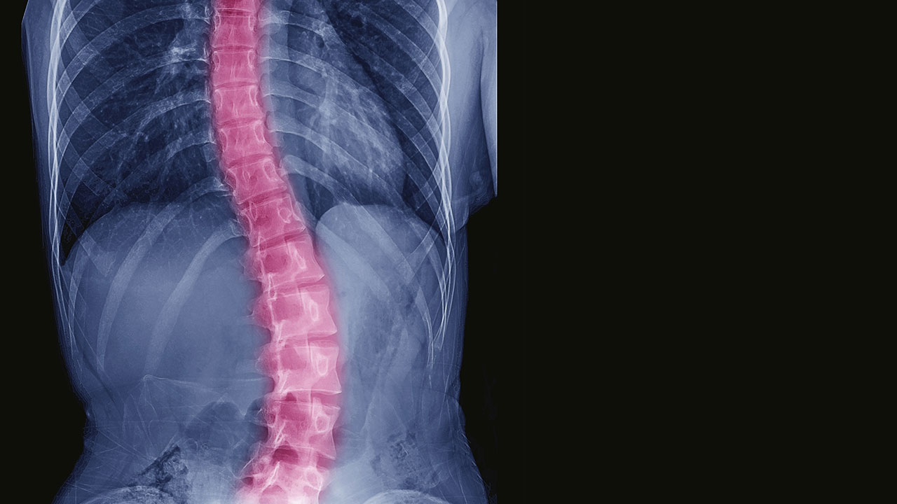 X-ray image of curved spine