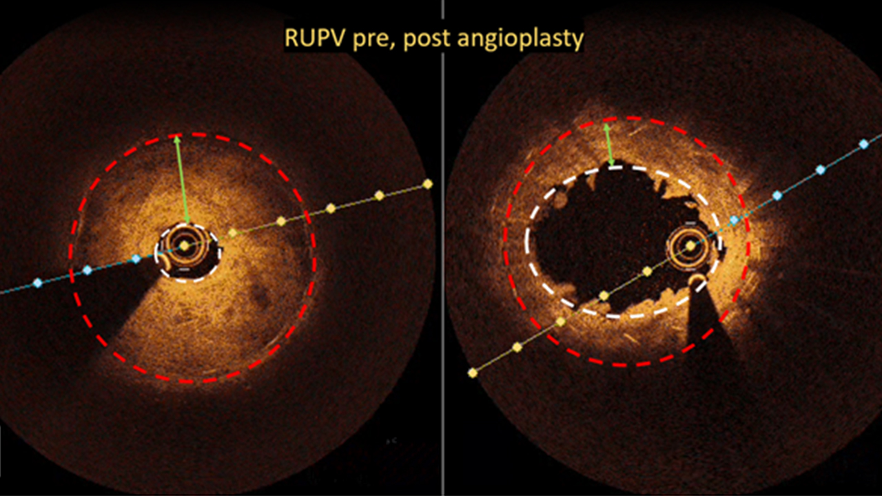 Optical coherence tomography image of right upper pulmonary vein stenosis pre, post angioplasty 