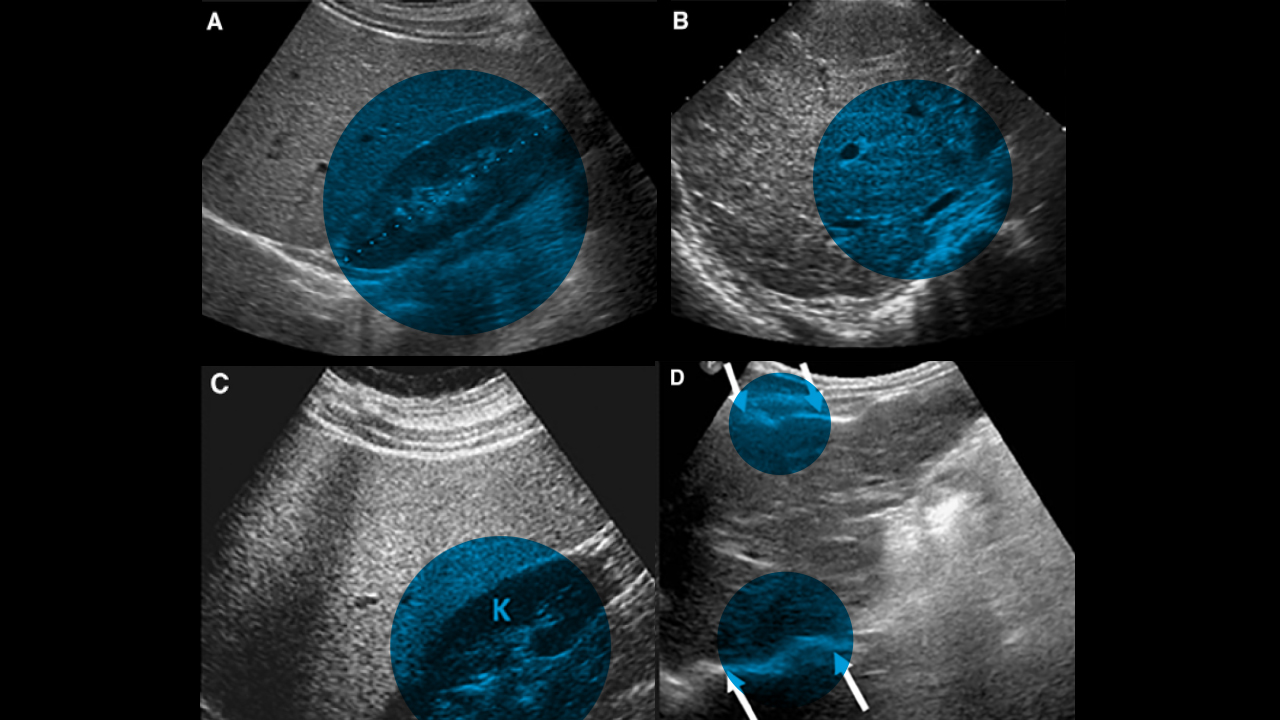 Scan of pediatric patient with cystic fibrosis liver disease