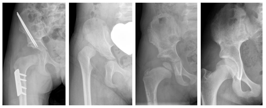 Multiple hip bone X-ray images. 