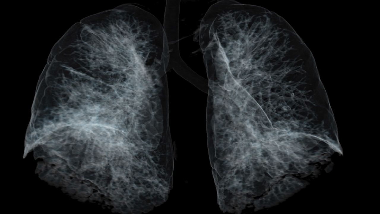  Black and white computed tomography (CT) scan of lungs.