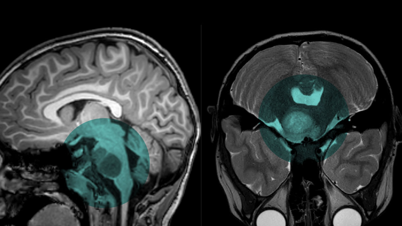 Side by side scans of the brain. Each has an area highlighted in blue showing a tumor.