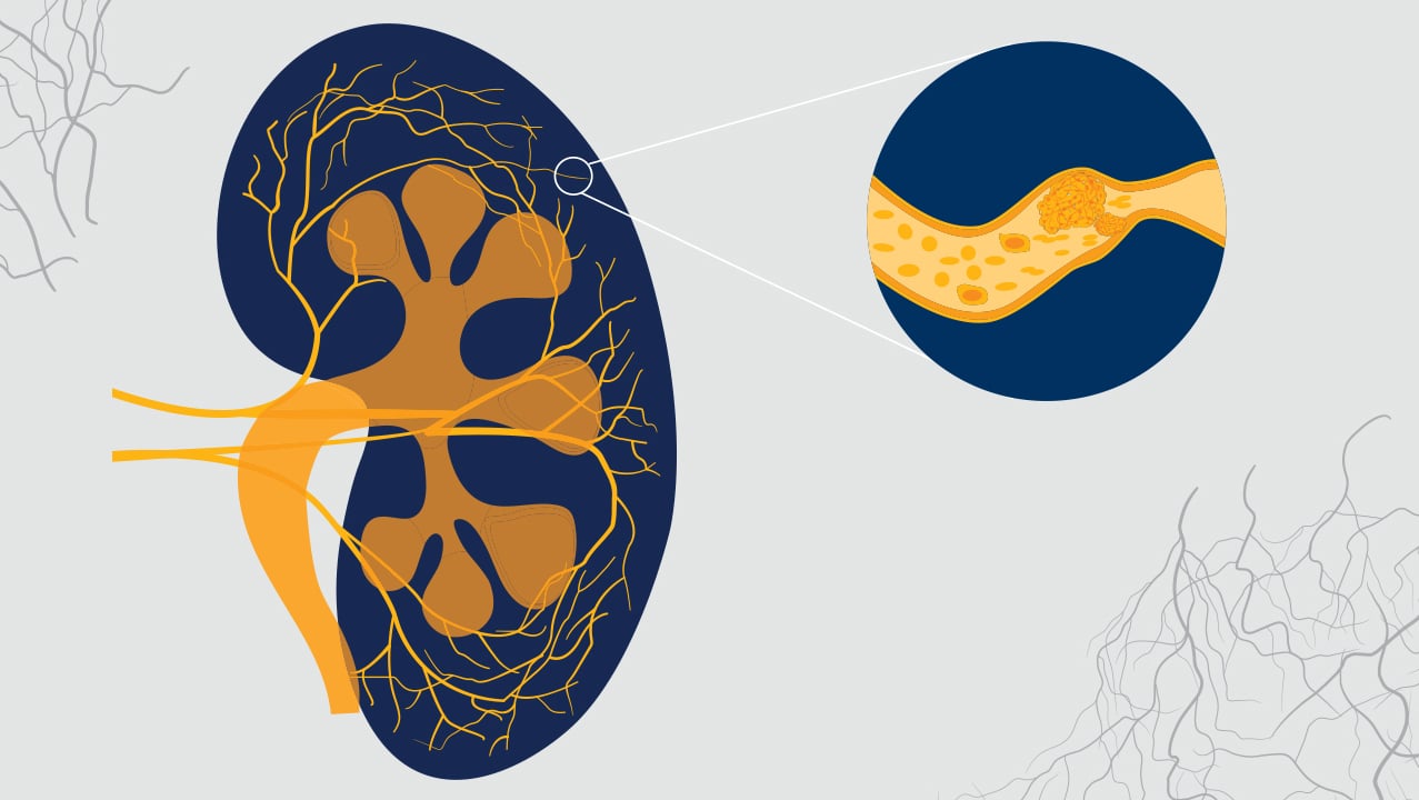 A dark blue illustration of a kidney with the veins and arteries that go through it in yellow. The background is grey with tiny dark grey capillaries laid over top. There is a dark blue circle highlighting a specific area of the kidney where the veins are blocked by the symptoms of aHUS.