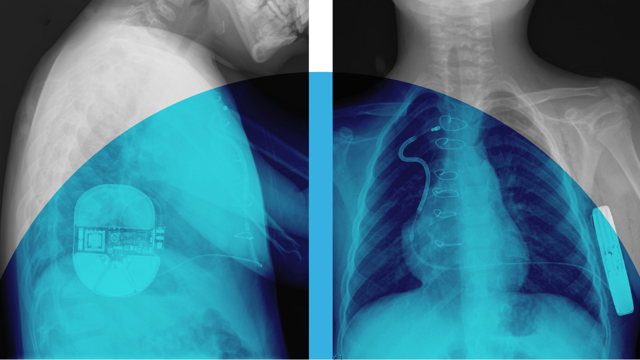 X-ray of S-ICD