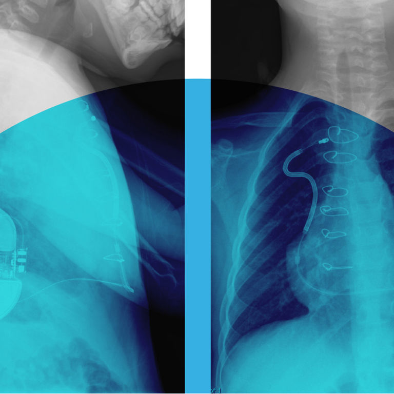 X-ray of S-ICD