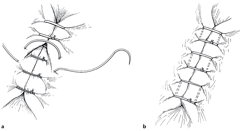 Illustration of the Colorado Fetal Care Center's modified hysterotomy closure technique.