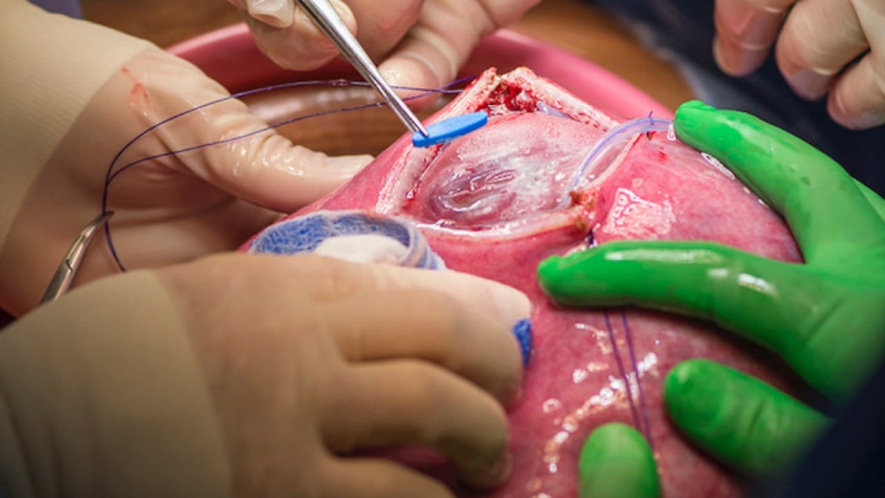 Surgeons perform an open fetal myelomeningocele repair as part of the their spina bifida research.