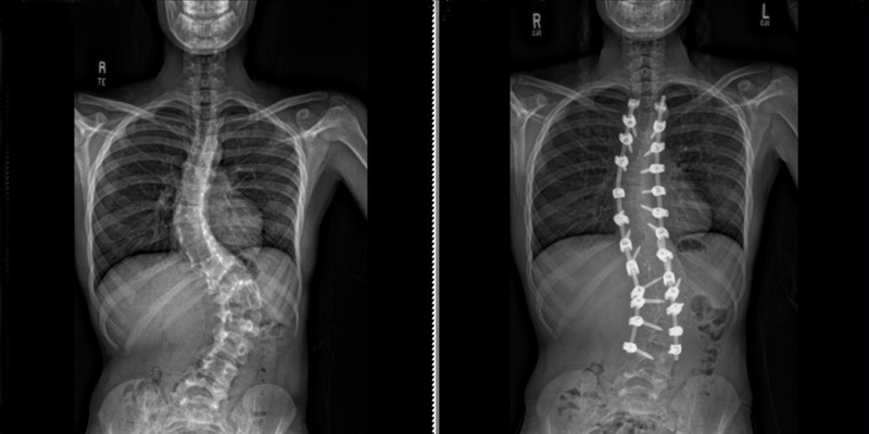 Two x-rays showing before and after perioperative surgery