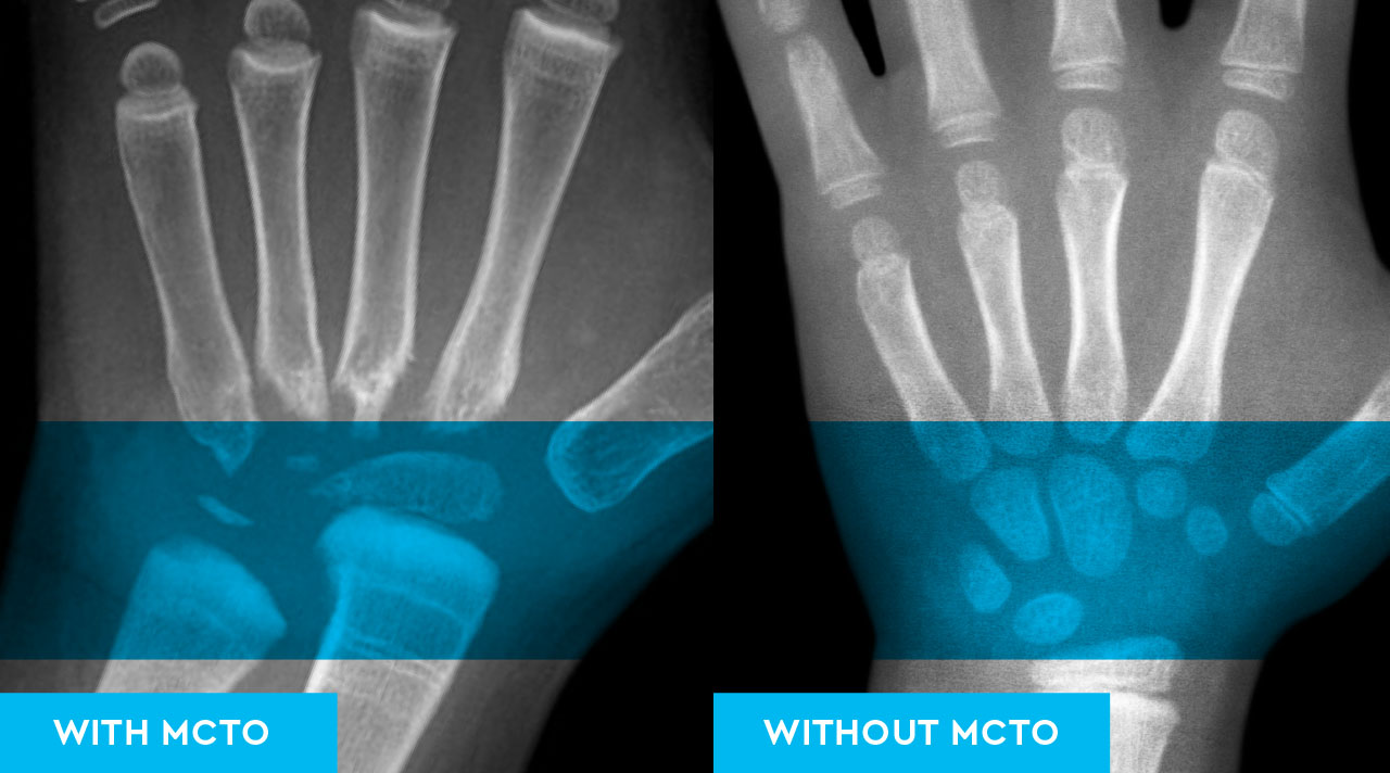 Two side-by-side X-ray images of hands. The one on the left has the label "With MCTO." The one on the right has the label "Without MCTO."