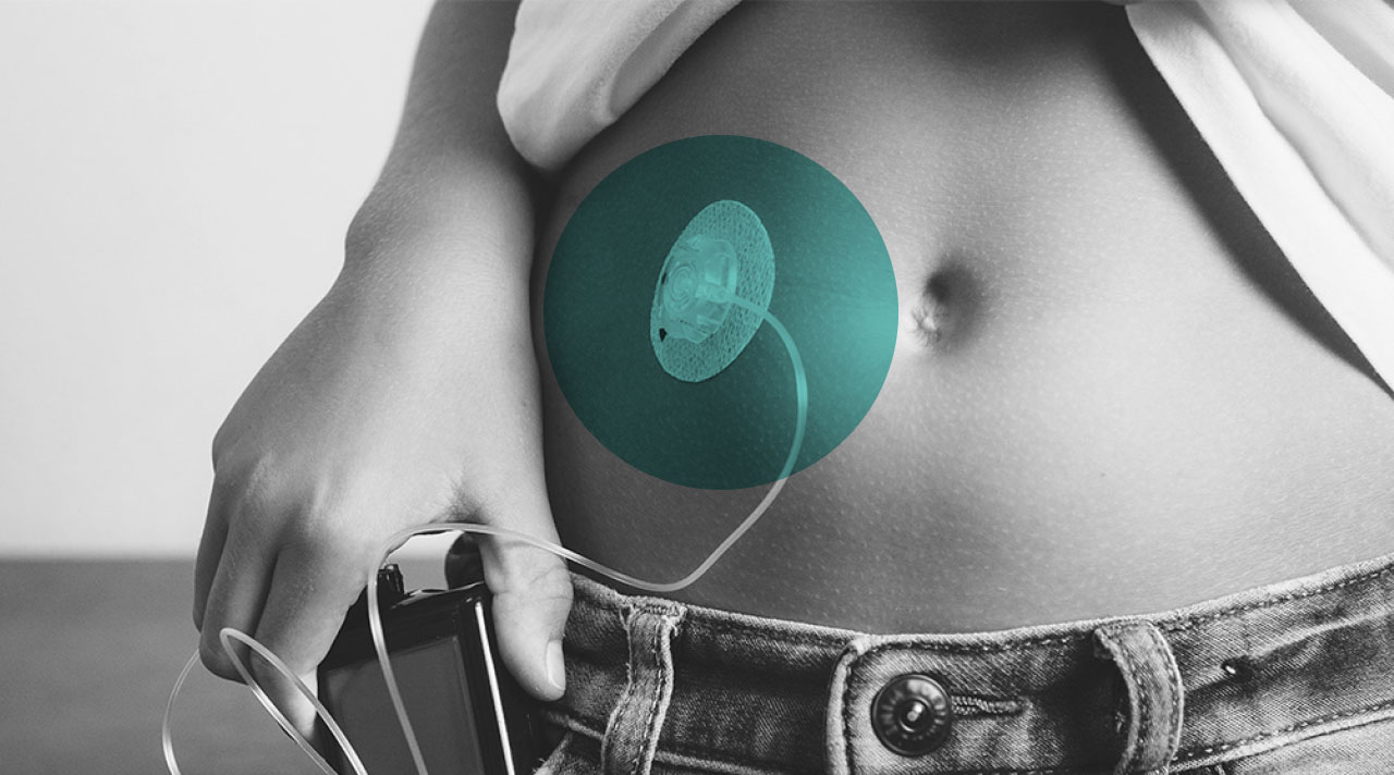 Stomach with insulin pump