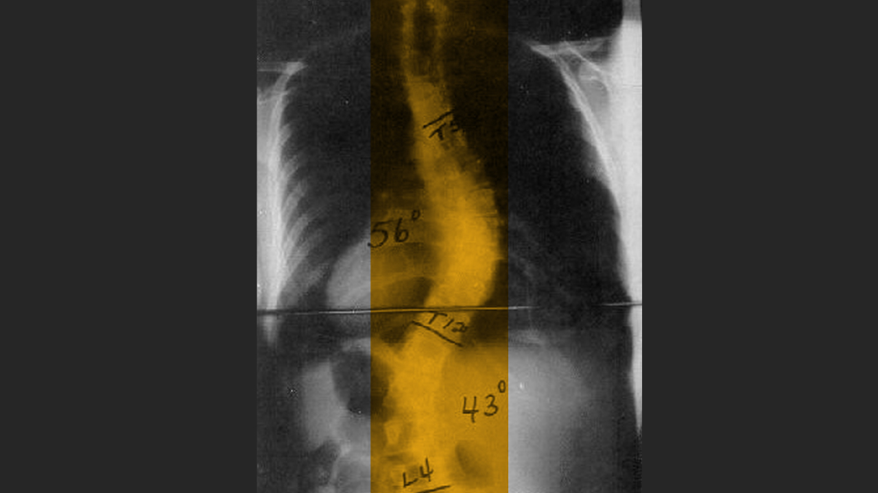 X-ray of scoliosis