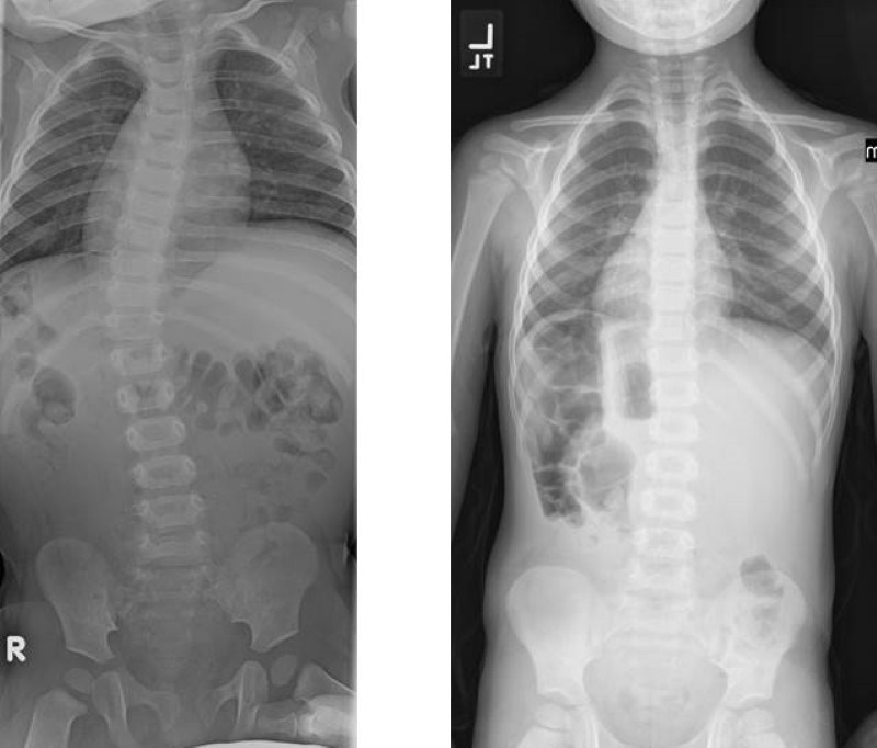 x-rays show the spine before (left) and after (right) casting was performed for scoliosis