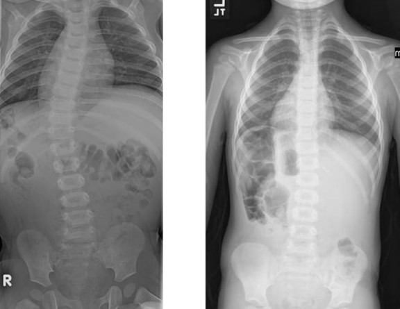 x-rays show the spine before (left) and after (right) casting was performed for scoliosis