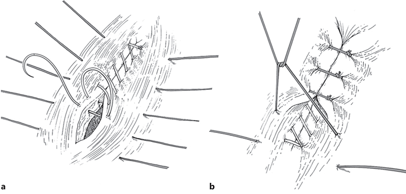 Illustration of a standard uterine closure following MMC repair.